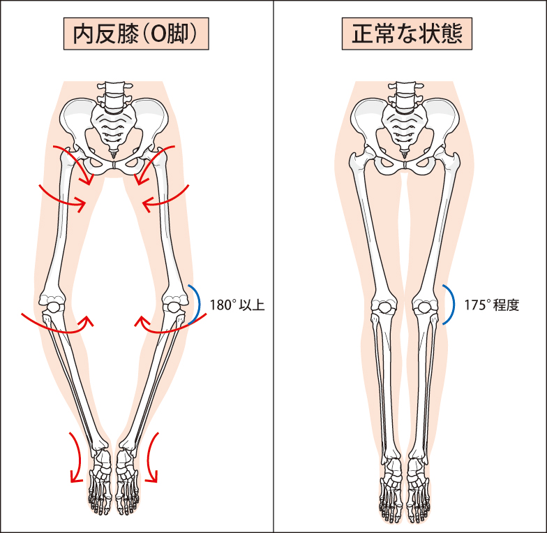 膝の変形や痛み 実は骨盤の歪みが影響しています❗️｜城東いまふく